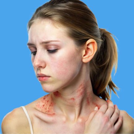 Skin Allergies