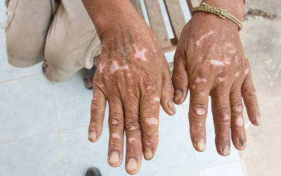 Close-up of dark-skinned hands with white patchy vitiligo on the backs of both hands, resting on a tiled floor.